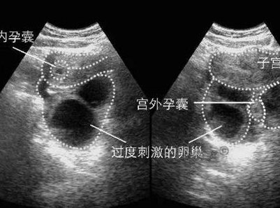 月年轻试管成功率越高吗？第三代试管竟受这些因素影响